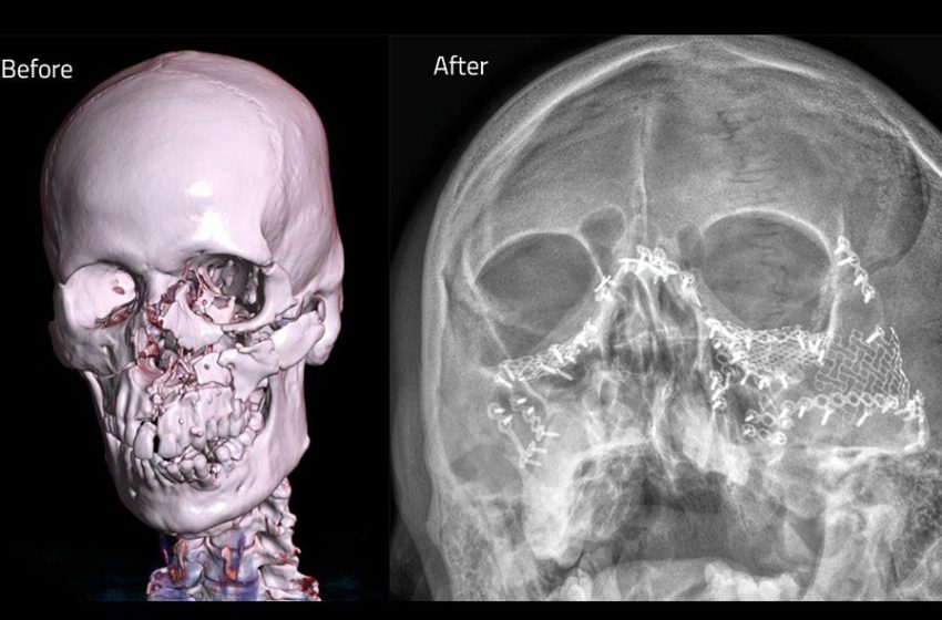  Doctors at Aster Hospital Mankhool rebuild 42-year-old man’s face after severe accident causes complex pan facial fractures